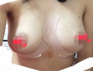 合肥華美趙輯做的曼托假體隆胸后我從A變成C罩杯