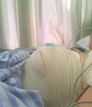 曼托毛面假體隆胸后我也是大胸妹子啦