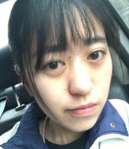 激光點(diǎn)痣不留坑不留疤，果棒棒噠