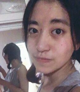 激光點(diǎn)痣不留坑不留疤，果棒棒噠