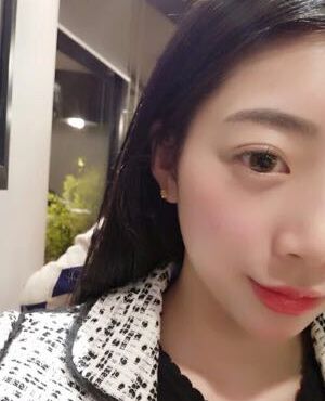 天津維美孫雪做的激光去雀斑后皮膚超干凈