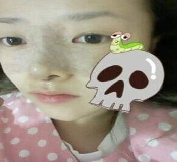 硅膠隆鼻手術圓了我高鼻梁的夢
