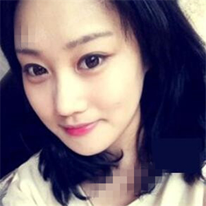 看看我磨下頜角整形手術(shù)恢復(fù)前后的對比圖片，同學(xué)都說我像張馨予~~