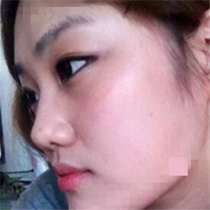 看看我磨下頜角整形手術(shù)恢復(fù)前后的對比圖片，同學(xué)都說我像張馨予~~