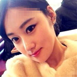 看看我磨下頜角整形手術(shù)恢復(fù)前后的對比圖片，同學(xué)都說我像張馨予~~