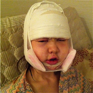 上海華美李志海做的v－line瓜子臉手術(shù)，果太好了~哈哈哈~