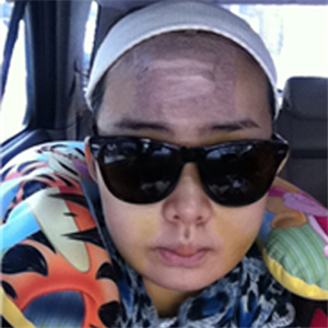 上海華美李志海做的v－line瓜子臉手術(shù)，果太好了~哈哈哈~