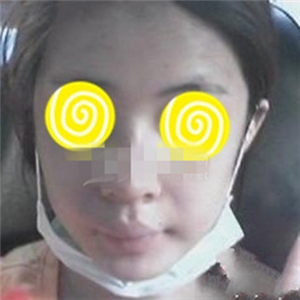 自體耳軟骨隆鼻手術(shù)恢復(fù)過程和前后對比圖分享，變化太大啦~~~