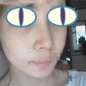 自體耳軟骨隆鼻手術(shù)恢復(fù)過程和前后對比圖分享，變化太大啦~~~