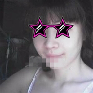 自體耳軟骨隆鼻手術(shù)恢復(fù)過程和前后對比圖分享，變化太大啦~~~