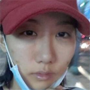 顴骨提高手術(shù)恢復(fù)前后的對比圖片分享，果很好的說~