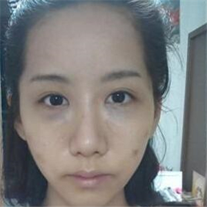 顴骨提高手術(shù)恢復(fù)前后的對比圖片分享，果很好的說~