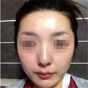 打B****告別大餅?zāi)?，恢?fù)前后的對比果照片給你們看看哦