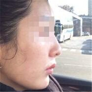 打B****告別大餅?zāi)?，恢?fù)前后的對比果照片給你們看看哦