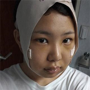 磨下頜角磨骨手術(shù)一個月了，分享一下恢復(fù)前后的果照片哇~