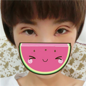 雙眼皮手術(shù)失敗修復(fù)一個月了，果不錯，有前后對比果圖片哦~