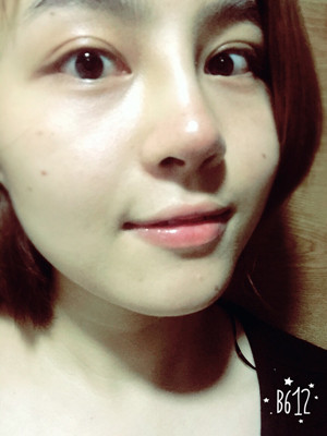 自體耳軟骨隆鼻后顏值上升了有沒(méi)有 莫琳娜葛紅做的