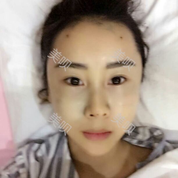 為大家分享一下韓國醫(yī)生給我做的全臉自體脂肪面部填充