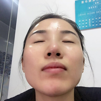 在惠州瑞芙臣做的隆鼻+玻尿酸隆下頜大家看看果怎么樣