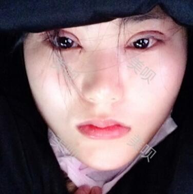 給大家看看我做的切開雙眼皮+開眼角恢復全過程很漂亮哦