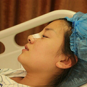 【真人案例】假體隆鼻手術(shù)前后過程分享