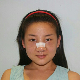 【真人案例】假體隆鼻手術(shù)前后過程分享