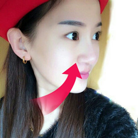 【真人案例】假體隆鼻手術(shù)前后過程分享