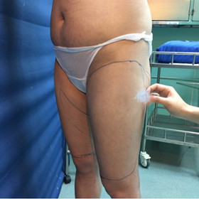 去年9月做的吸脂手術(shù)，大家來看看果怎么樣