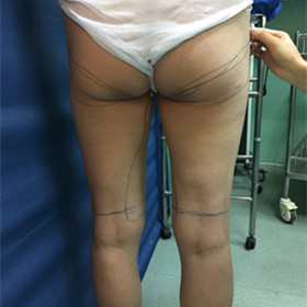 去年9月做的吸脂手術(shù)，大家來看看果怎么樣