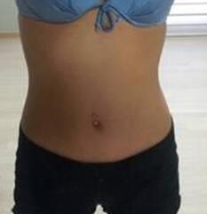 北京清木腰腹吸脂3個月感受