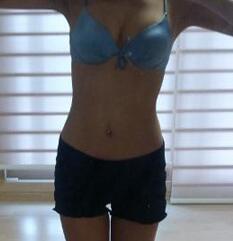 北京清木腰腹吸脂3個月感受