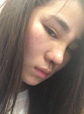 巨丑的鼻子做了隆鼻整形之后順眼多了