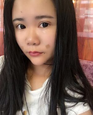 自體脂肪面部填充后臉型**了很多