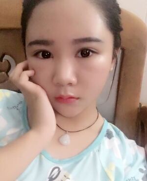 自體脂肪面部填充后臉型**了很多