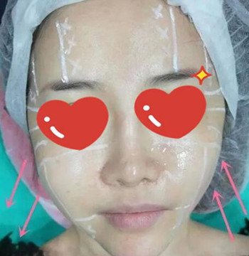 做了拉皮除皺 我的皮膚越來越緊致光滑了