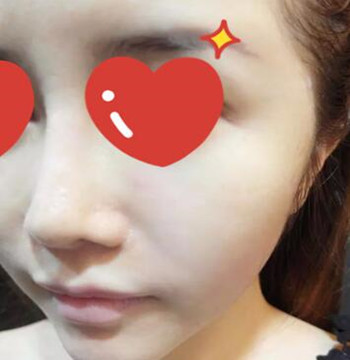 做了拉皮除皺 我的皮膚越來越緊致光滑了