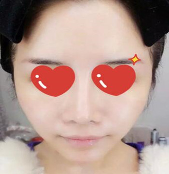 做了拉皮除皺 我的皮膚越來越緊致光滑了