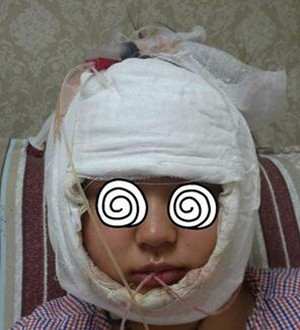 柳大烈教授幫我做磨骨瘦臉 真的很安有果也很棒