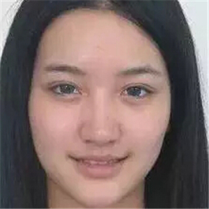 去年做的注射B****微整形，你們看看恢復(fù)前后的對比照片~~~