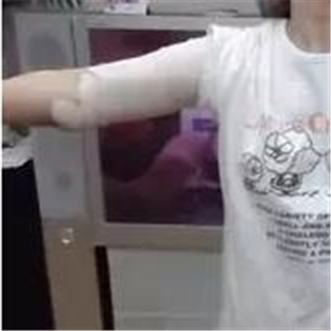 手臂吸脂手術(shù)八個月了，看看我的前后對比果圖片吧~~