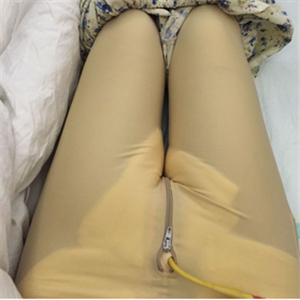 大腿部吸脂減肥一個月了，曬一下恢復過程和對比照片哇~~