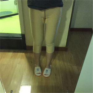 大腿部吸脂減肥一個月了，曬一下恢復過程和對比照片哇~~