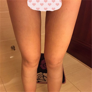 大腿部吸脂減肥一個月了，曬一下恢復過程和對比照片哇~~