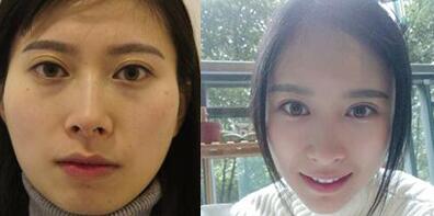 大腿吸脂做自體脂肪面部填充三個月的前后對比照片