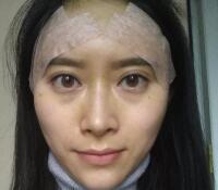 大腿吸脂做自體脂肪面部填充三個月了，分享給大家