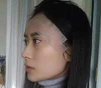 大腿吸脂做自體脂肪面部填充三個月了，分享給大家