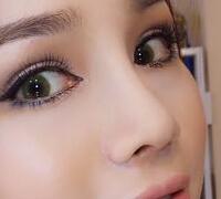 隆鼻整形真實(shí)案例恢復(fù)過(guò)程分享