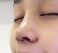 隆鼻整形真實(shí)案例恢復(fù)過(guò)程分享