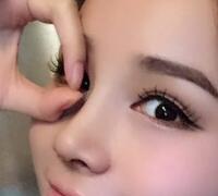 隆鼻整形真實(shí)案例恢復(fù)過(guò)程分享