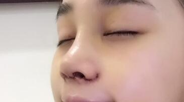 隆鼻整形手術(shù)后恢復(fù)圖